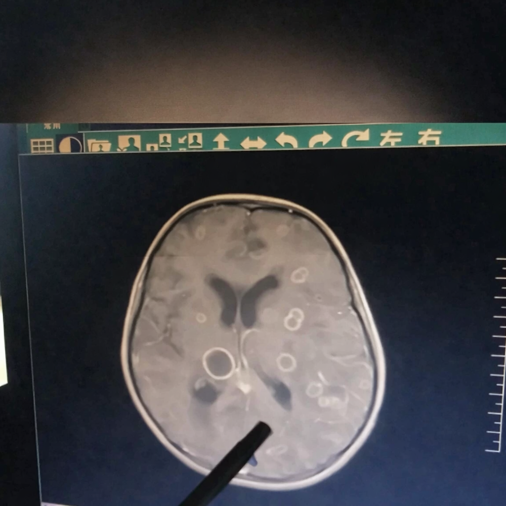 Bé gái lớp 2 não 