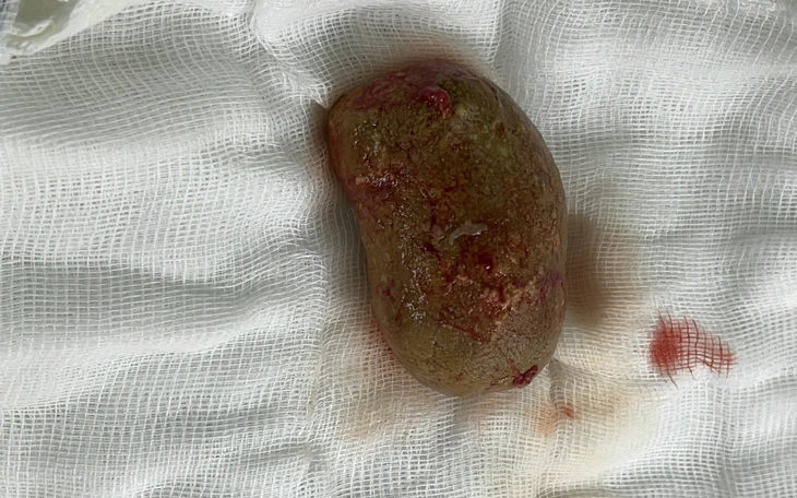 Ăn mặn, thiếu chất xơ, uống ít nước Việt Nam có tỉ lệ mắc sỏi tiết niệu cao nhất thế giới - Ảnh 2.