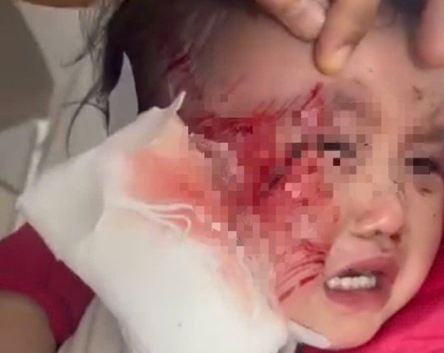 Sập trần thạch cao giờ ngủ trưa, một trẻ mầm non bị thương nặng- Ảnh 1.