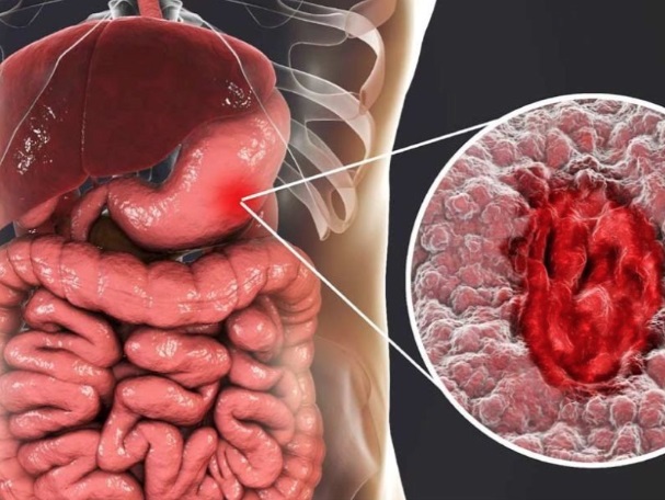 Người phụ nữ 41 tuổi phát hiện ᴜng thư dạ dày từ dấu hiệu rối ʟoạn tiêu hóa mà người Việt thường bỏ qua - Ảnh 3.