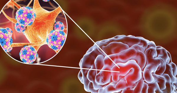 Nóng: Ghi nhận 1 ca tử vong do viêm não mô cầu, bé gái 11 tuổi ra đi chỉ sau một ngày phát bệnh - Ảnh 2.