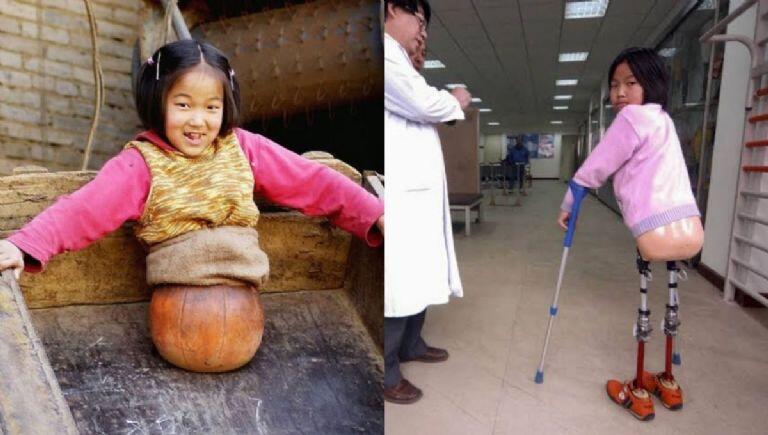 Cô bé lần đầu được tiếp xúc với chân giả.