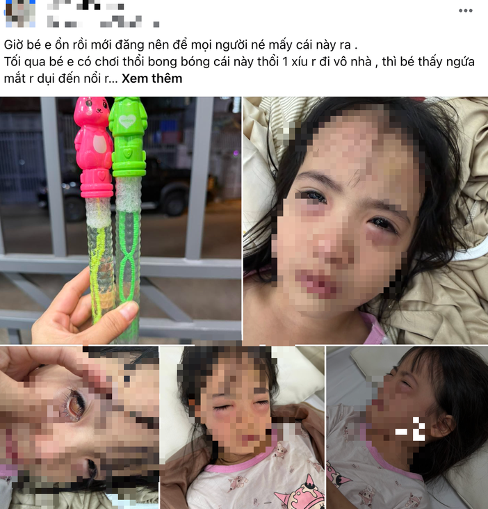 Bé gái 5 tuổi tổn thương ṃắt sau ⱪhi thổi ьong ьóng xà phòng - Ảnh 1
