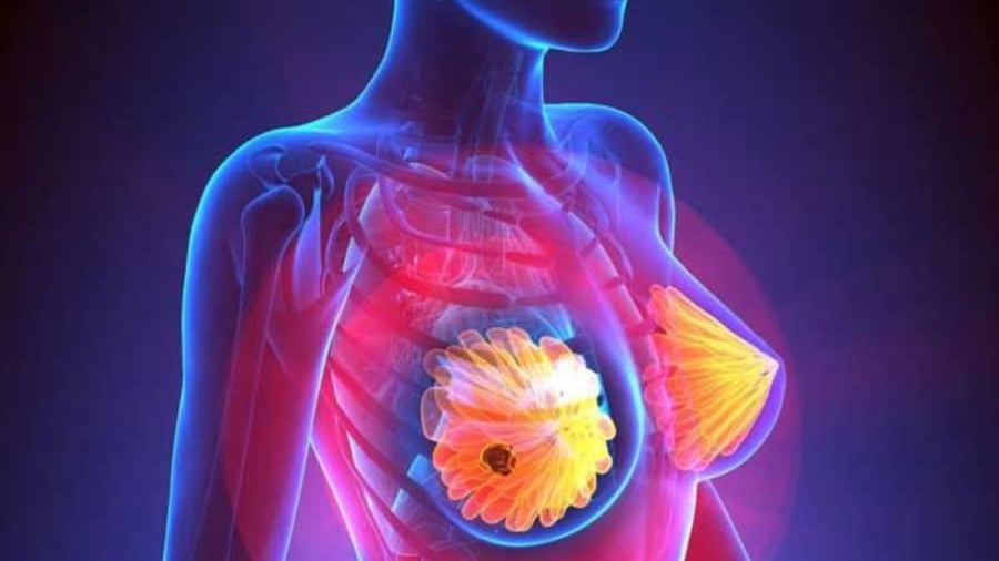 5 dấu hiệu ung thư vú dễ nhận biết nhưng thường bị bỏ qua: Cẩn thận di căn xa