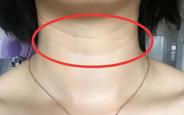 Bác sĩ khuyến cáo: Xuất hiện 3 biểu hiện này ở cổ cần sớm thăm khám